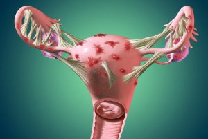 Кисты и миомы